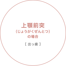 上顎前突（じょうがくぜんとつ）の場合