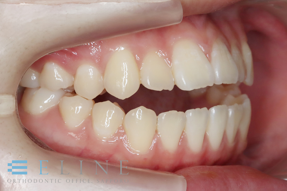 骨格性開咬（1）