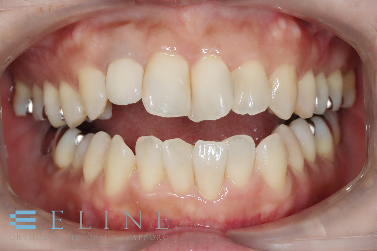 骨格性開咬（2）