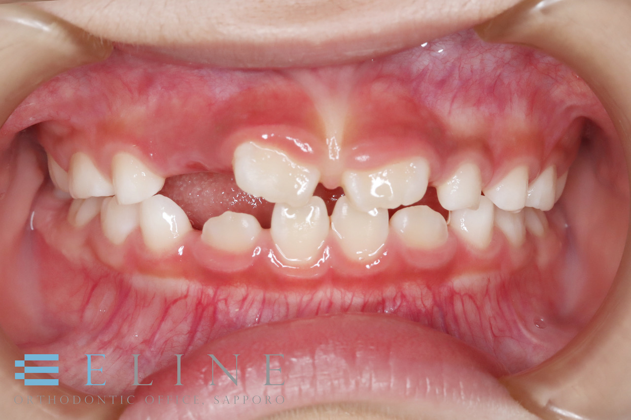 「上唇小帯」が原因のすきっ歯