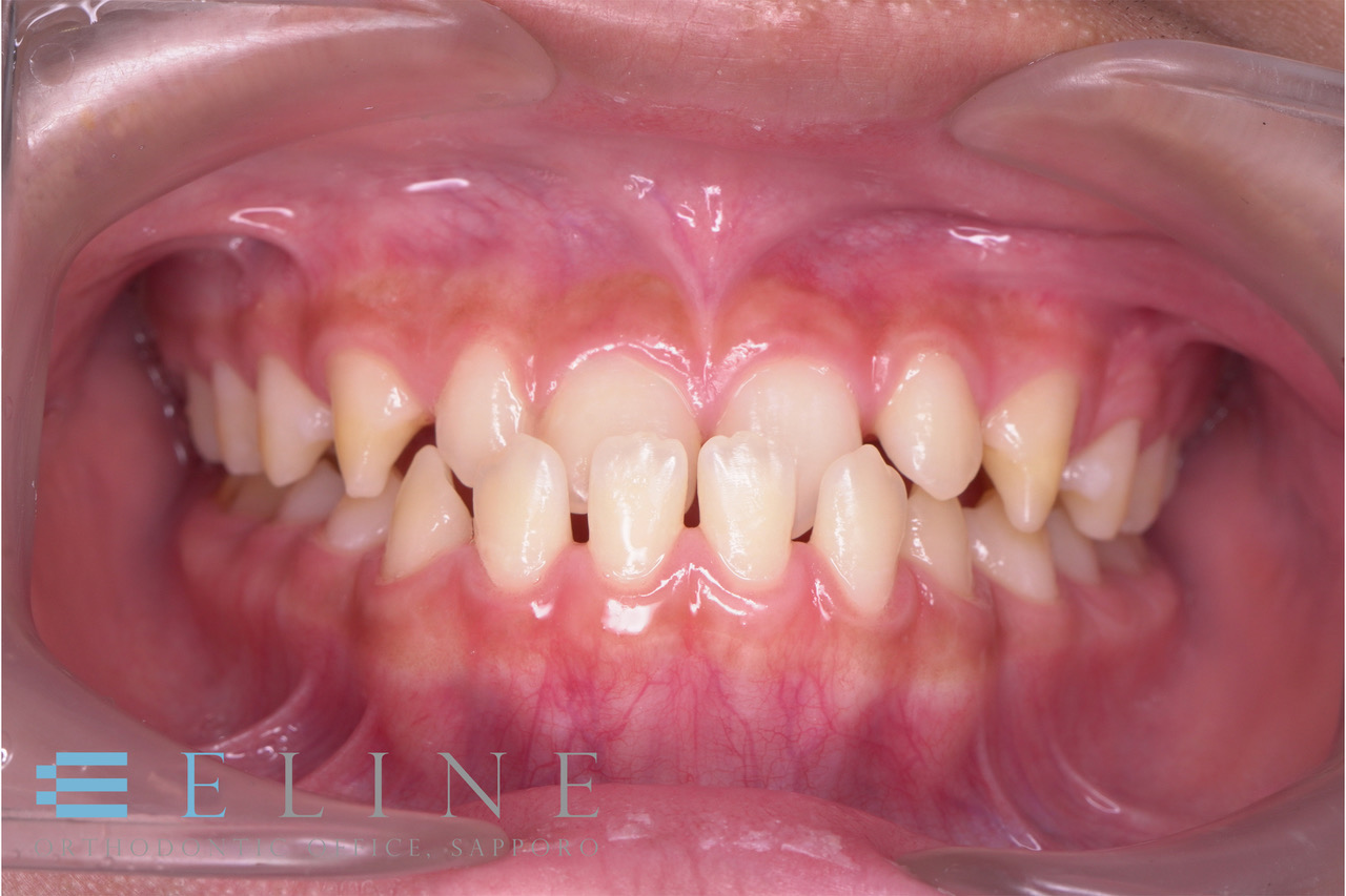 「反対咬合」ですきっ歯