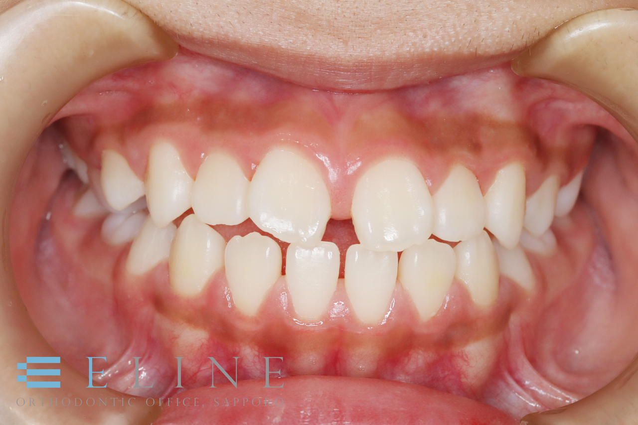 「舌突出癖」によるすきっ歯